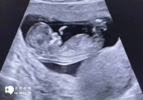 不是每个人都能做无痛分娩，这几类不能做无痛分娩的人群有你一个吗？